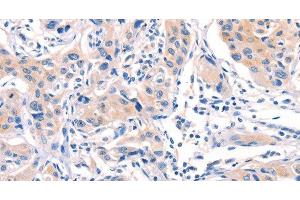 Immunohistochemistry of paraffin-embedded Human lung cancer tissue using AFDN Polyclonal Antibody at dilution 1:40 (Afadin Antikörper)
