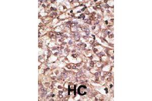 Formalin-fixed and paraffin-embedded human hepatocellular carcinoma tissue reacted with DKK4 polyclonal antibody  , which was peroxidase-conjugated to the secondary antibody, followed by DAB staining. (DKK4 Antikörper  (C-Term))
