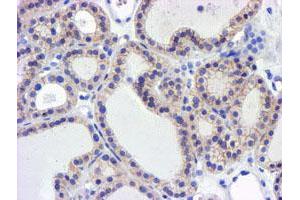 Immunohistochemical staining of paraffin-embedded Carcinoma of Human thyroid tissue using anti-GSTO2 mouse monoclonal antibody. (GSTO2 Antikörper)