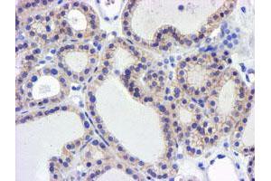 Immunohistochemical staining of paraffin-embedded Carcinoma of Human thyroid tissue using anti-GSTO2 mouse monoclonal antibody.