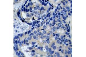 Immunohistochemistry of paraffin-embedded human breast carcinoma using Phospho-PTK2B-Y402 antibody (ABIN2987623).