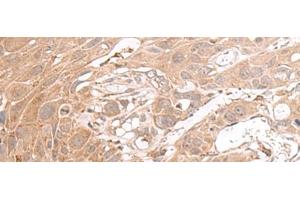 Immunohistochemistry of paraffin-embedded Human esophagus cancer tissue using CHST4 Polyclonal Antibody at dilution of 1:35(x200) (CHST4 Antikörper)