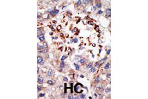 Formalin-fixed and paraffin-embedded human hepatocellular carcinoma tissue reacted with CBX8 polyclonal antibody  , which was peroxidase-conjugated to the secondary antibody, followed by DAB staining . (CBX8 Antikörper  (C-Term))