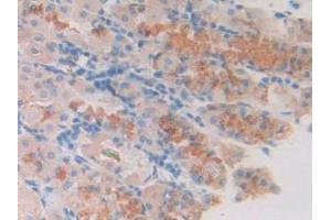 IHC-P analysis of Human Stomach Cancer Tissue, with DAB staining. (SLIT1 Antikörper  (AA 647-835))