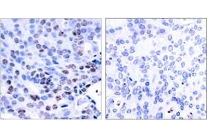 Immunohistochemistry analysis of paraffin-embedded human breast carcinoma tissue, using NF-kappaB p105/p50 (Ab-337) Antibody. (NFKB1 Antikörper  (AA 304-353))