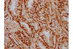 IHC image of ABIN7155735 diluted at 1:600 and staining in paraffin-embedded human prostate cancer performed on a Leica BondTM system. (HOXB3 Antikörper  (AA 315-423))