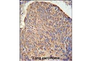 C Antibody (Center) (ABIN650934 and ABIN2840000) IHC analysis in formalin fixed and paraffin embedded human lung carcinoma followed by peroxidase conjugation of the secondary antibody and DAB staining. (CCDC130 Antikörper  (AA 173-200))