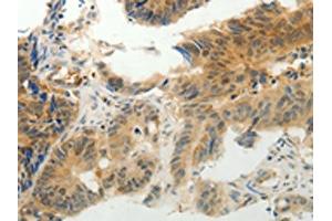 The image on the left is immunohistochemistry of paraffin-embedded Human colon cancer tissue using ABIN7190314(CMTM7 Antibody) at dilution 1/30, on the right is treated with synthetic peptide. (CMTM7 Antikörper)