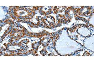Immunohistochemistry of paraffin-embedded Human thyroid cancer using ALDH6A1 Polyclonal Antibody at dilution of 1:45 (ALDH6A1 Antikörper)