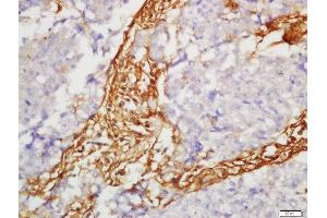 Formalin-fixed and paraffin embedded human lung carcinoma labeled with Anti-SLC7A5 Polyclonal Antibody, Unconjugated  at 1:200 followed by conjugation to the secondary antibody and DAB staining (SLC7A5 Antikörper  (AA 101-200))
