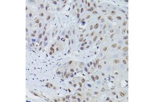 Immunohistochemistry of paraffin-embedded human esophageal cancer using MRE11 Rabbit pAb (ABIN3016249, ABIN3016250, ABIN3016251 and ABIN6219660) at dilution of 1:50 (40x lens). (Mre11 Antikörper  (AA 1-205))
