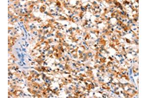The image on the left is immunohistochemistry of paraffin-embedded Human thyroid cancer tissue using ABIN7192636(SPRN Antibody) at dilution 1/15, on the right is treated with synthetic peptide.