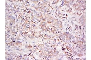 Formalin-fixed and paraffin embedded human lung carcinoma labeled with Anti-LDLRAD3 Polyclonal Antibody, Unconjugated  at 1:500 followed by conjugation to the secondary antibody and DAB staining (LDLRAD3 Antikörper  (AA 101-200))