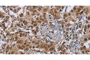Immunohistochemistry of paraffin-embedded Human liver cancer using GTF2I Polyclonal Antibody at dilution of 1:40