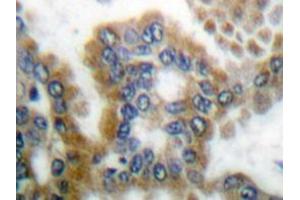 Immunohistochemistry analyzes of CrkL antibody in paraffin-embedded human lung carcinoma tissue. (CrkL Antikörper)