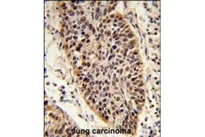 Formalin-fixed and raffin-embedded human lung carcinoma reacted with X Antibody (C-term), which was peroxidase-conjugated to the secondary antibody, followed by DAB staining. (XPA Antikörper  (C-Term))