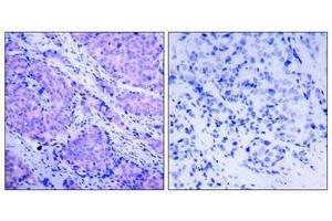 Immunohistochemical analysis of paraffin-embedded human breast carcinoma tissue using PDK1(Phospho-Ser241) Antibody(left) or the same antibody preincubated with blocking peptide(right). (PDPK1 Antikörper  (pSer241))