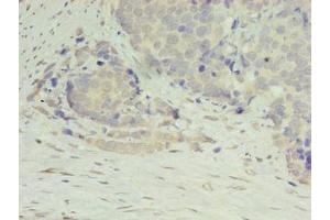 Immunohistochemistry of paraffin-embedded human gastric cancer using ABIN7150021 at dilution of 1:100 (DIP2A Antikörper  (AA 1-300))