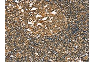 The image on the left is immunohistochemistry of paraffin-embedded Human tonsil tissue using ABIN7192667(STAB1 Antibody) at dilution 1/20, on the right is treated with synthetic peptide. (Stabilin 1 Antikörper)