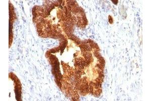 Formalin-fixed, paraffin-embedded human prostate carcinoma stained with Cytokeratin 18 antibody (KRT18/835). (Cytokeratin 18 Antikörper)