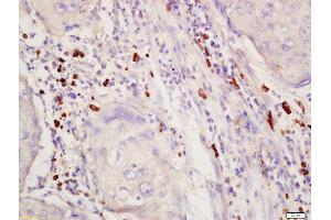 Formalin-fixed and paraffin embedded human lung cancer labeled with Rabbit Anti-SGK1 (Thr256) Polyclonal Antibody, Unconjugated 1:200 followed by conjugation to the secondary antibody and DAB staining (SGK1 Antikörper  (pThr256))
