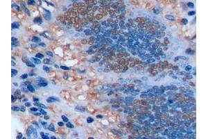 Detection of Ki-67 in Human Colorectal cancer Tissue using Polyclonal Antibody to Ki-67 Protein (Ki-67) (Ki-67 Antikörper  (AA 2815-2928))