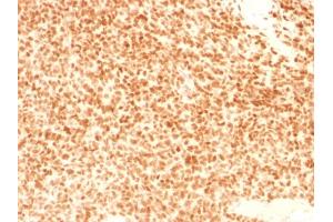 Formalin-fixed, paraffin-embedded human Ewing's Sarcoma stained with NKX2. (Nkx2-2 Antikörper  (AA 1-119))