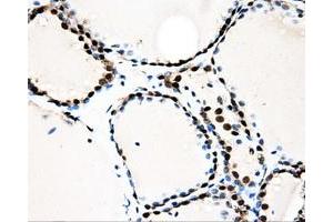 Immunohistochemical staining of paraffin-embedded Adenocarcinoma of ovary tissue using anti-LOXmouse monoclonal antibody. (LOX Antikörper  (AA 22-168))