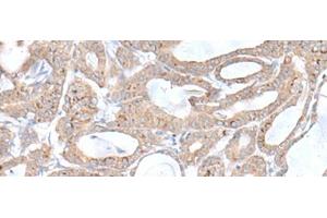 Immunohistochemistry of paraffin-embedded Human thyroid cancer tissue using PLGLB2 Polyclonal Antibody at dilution of 1:65(x200) (PLGLB2 Antikörper)