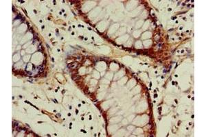 Immunohistochemistry of paraffin-embedded human colon cancer using ABIN7142946 at dilution of 1:100