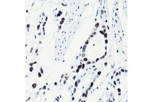 Immunohistochemistry of paraffin-embedded human gastric cancer using Acetyl-Histone H2B-K5 antibody (ABIN7267733) at dilution of 1:100 (40x lens).