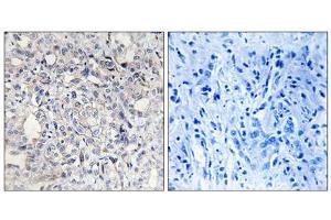 Immunohistochemistry analysis of paraffin-embedded human liver carcinoma tissue, using Heparin Cofactor II antibody. (SERPIND1 Antikörper  (N-Term))