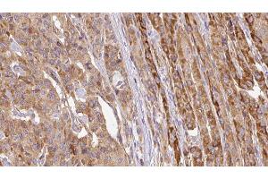 ABIN6267110 at 1/100 staining Human thyroid cancer tissue by IHC-P.