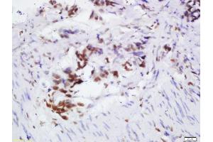 Formalin-fixed and paraffin embedded human colon cancer labeled with Rabbit Anti-OGG1 Polyclonal Antibody, Unconjugated 1:200 followed by conjugation to the secondary antibody and DAB staining, (OGG1 Antikörper  (AA 151-250))