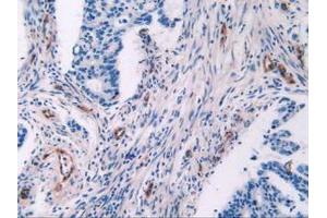 IHC-P analysis of Human Rectum Cancer Tissue, with DAB staining. (Endoglin Antikörper  (AA 26-136))