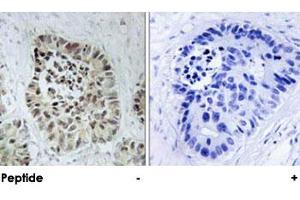 Immunohistochemical analysis of paraffin-embedded human lung carcinoma tissue using DCLRE1C polyclonal antibody . (DCLRE1C Antikörper)