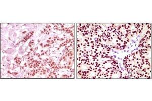 Immunohistochemical analysis of paraffin-embedded human breast carcinoma, using ER-alpha mouse mAb showing nuclear expression with DAB staining. (Estrogen Receptor alpha Antikörper)