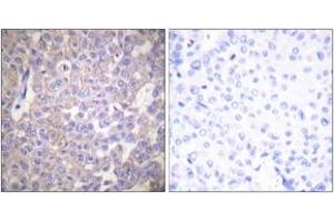 Immunohistochemistry analysis of paraffin-embedded human breast carcinoma tissue, using Claudin 2 Antibody. (Claudin 2 Antikörper  (AA 181-230))