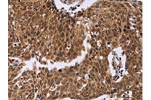The image on the left is immunohistochemistry of paraffin-embedded Human cervical cancer tissue using ABIN7129394(ERCC6L Antibody) at dilution 1/30, on the right is treated with fusion protein. (ERCC6L Antikörper)