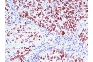 Formalin-fixed, paraffin-embedded human lung carcinoma stained with TTF1 antibody (8G7G3/1 + NX2. (TTF1 Antikörper)