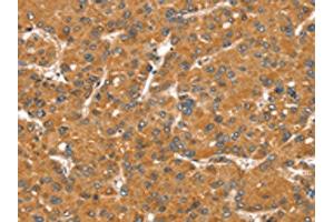 The image on the left is immunohistochemistry of paraffin-embedded Human liver cancer tissue using ABIN7131123(SNX11 Antibody) at dilution 1/30, on the right is treated with fusion protein. (SNX11 Antikörper)