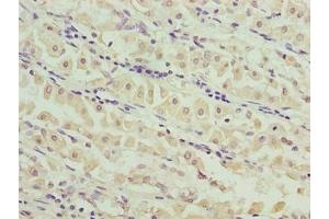 Immunohistochemistry of paraffin-embedded human gastric cancer using ABIN7159191 at dilution of 1:100 (MND1 Antikörper  (AA 2-205))