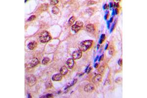 Immunohistochemical analysis of CDC6 (pS54) staining in human breast cancer formalin fixed paraffin embedded tissue section. (CDC6 Antikörper  (N-Term, pSer54))