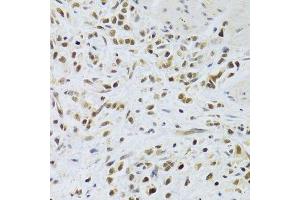 Immunohistochemistry of paraffin-embedded human gastric cancer using RAD50 Antibody. (RAD50 Antikörper)