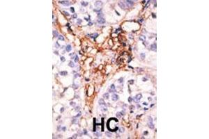 Formalin-fixed and paraffin-embedded human cancer tissue reacted with the primary antibody, which was peroxidase-conjugated to the secondary antibody, followed by AEC staining. (APOBEC3G Antikörper  (AA 118-148))