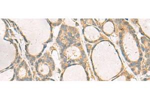 Immunohistochemistry of paraffin-embedded Human thyroid cancer tissue using KIF2C Polyclonal Antibody at dilution of 1:70(x200) (KIF2C Antikörper)