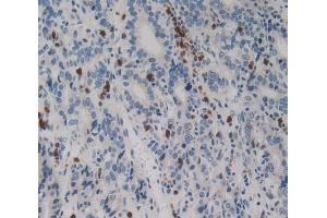 Used in DAB staining on fromalin fixed paraffin- embedded stomach cancer tissue (Netrin 4 Antikörper  (AA 349-592))