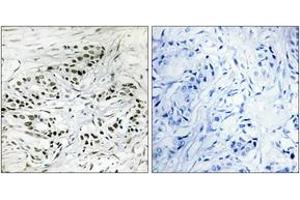 Immunohistochemistry analysis of paraffin-embedded human breast carcinoma tissue, using ERF Antibody.