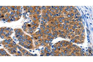 Immunohistochemistry of paraffin-embedded Human liver cancer using IGF2BP1 Polyclonal Antibody at dilution of 1:40 (IGF2BP1 Antikörper)
