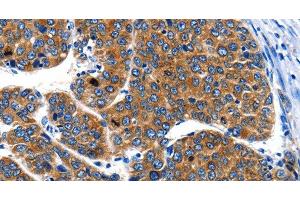 Immunohistochemistry of paraffin-embedded Human liver cancer using IGF2BP1 Polyclonal Antibody at dilution of 1:40